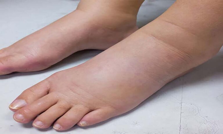 পায়ে পানি কেন আসে? জেনে নিন