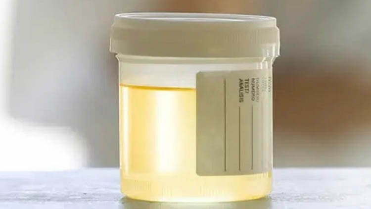 প্রস্রাবের রং দেখে রোগ চেনা যায়