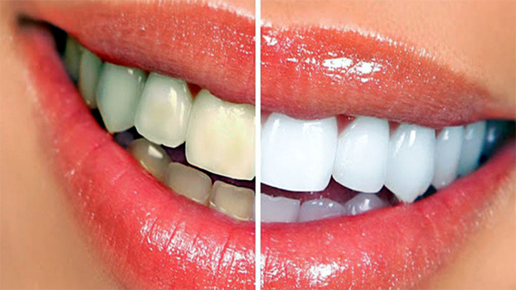 দাঁতের কালো বা হলুদ দাগ তুলবেন যেভাবে