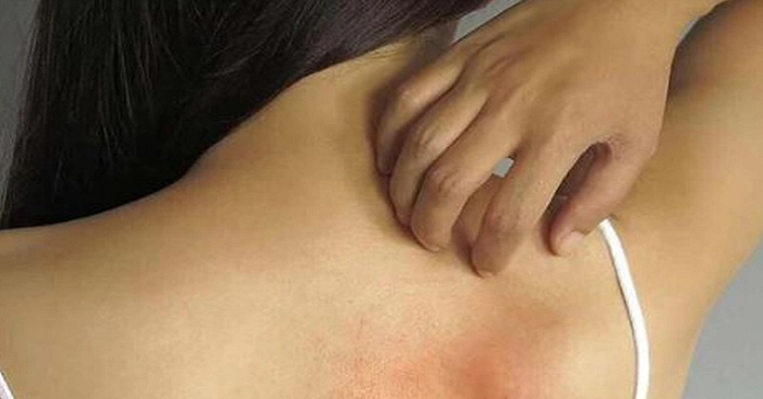 গরমে ঘামাচির যন্ত্রণা? যা করবেন